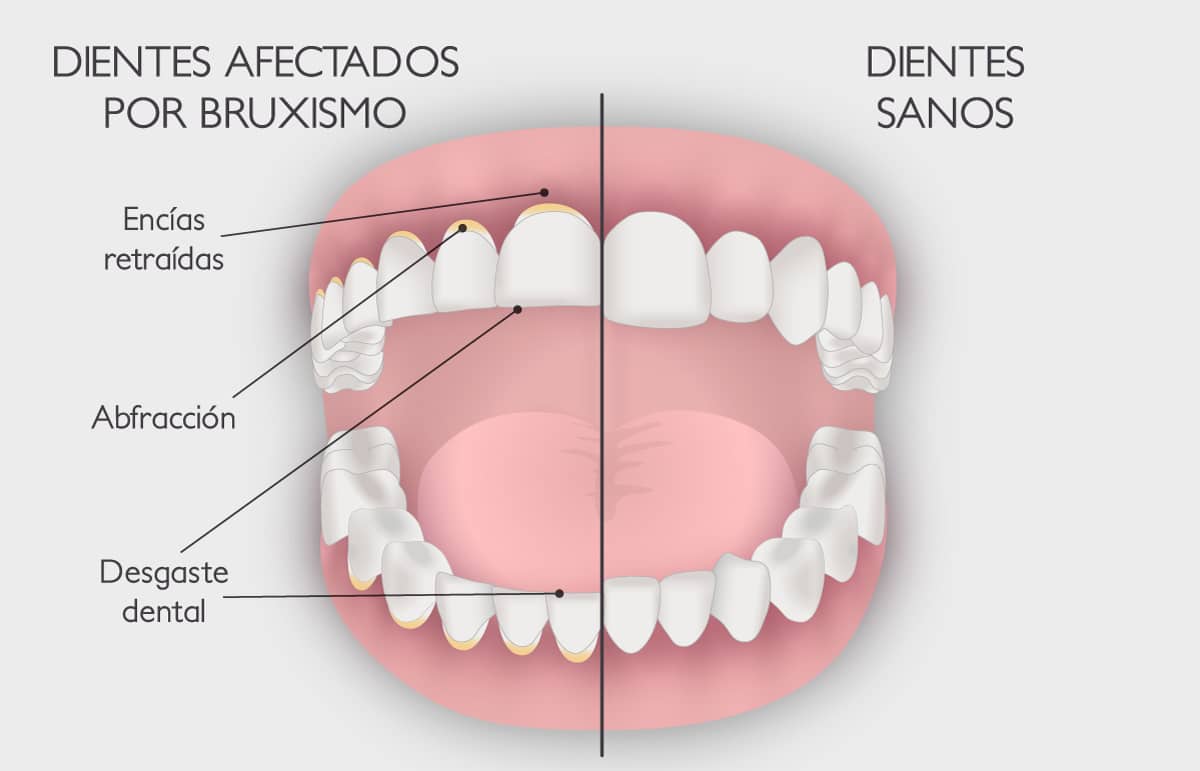 Aprietas los dientes en la noche? Conoce las soluciones que existen para el  bruxismo